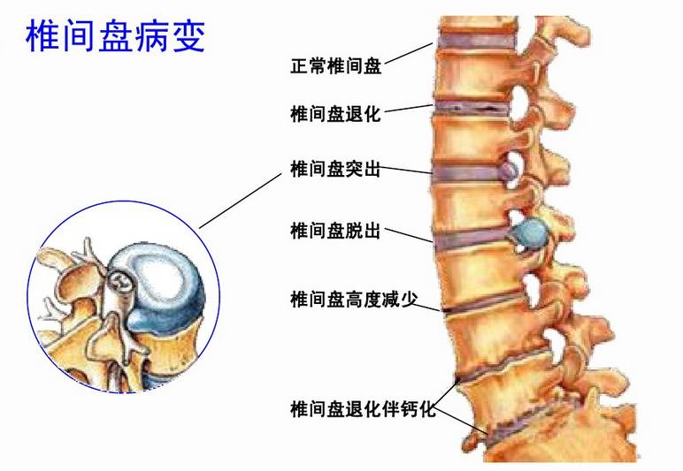 腰间盘突出最新疗法研究与应用进展