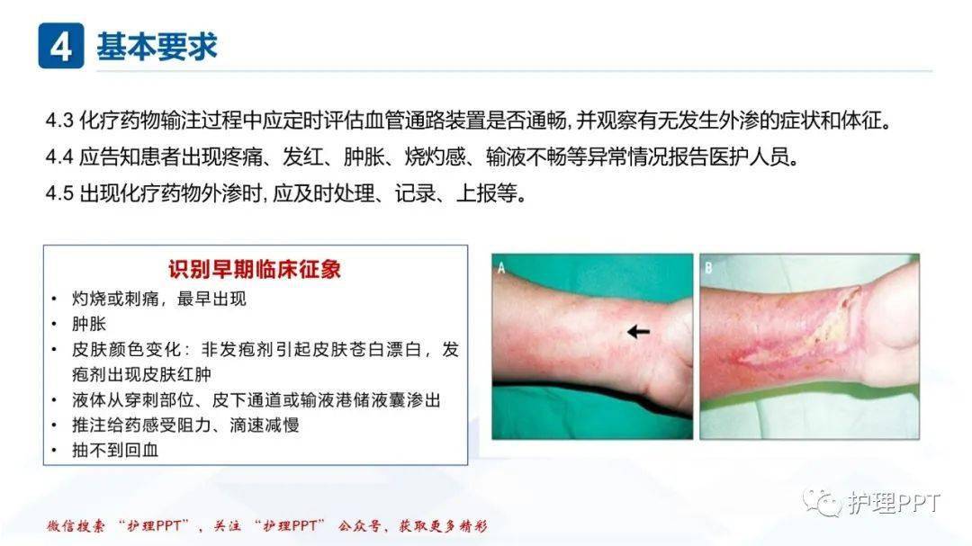 胺碘酮外渗最新处理方法研究